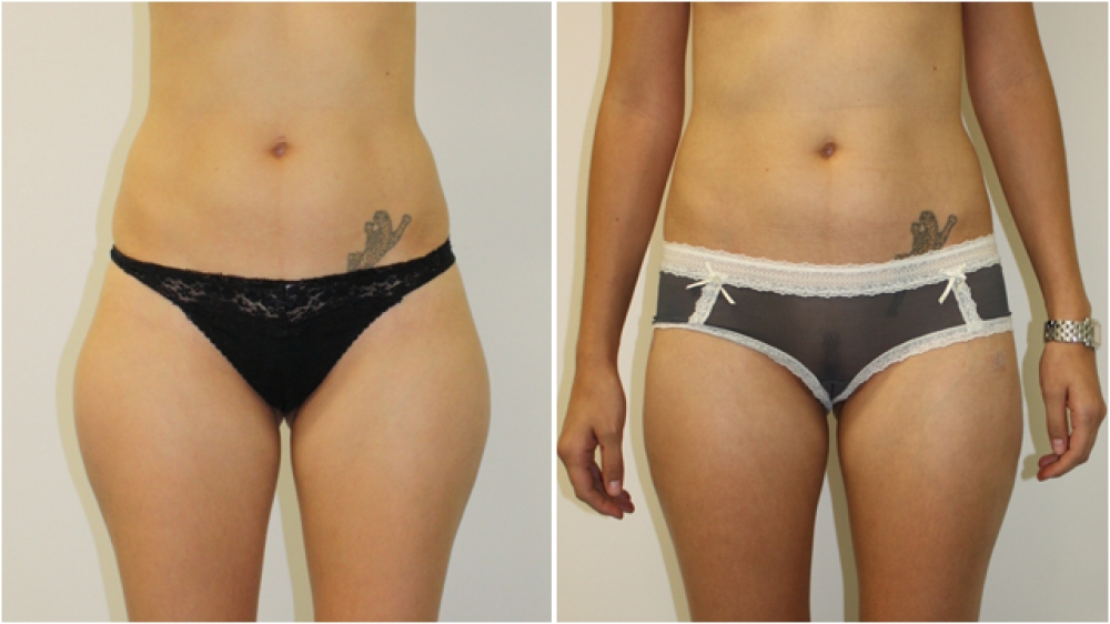 This 30 year old lady underwent liposuction to her outer thighs, buttocks and flanks to achieve a more streamlined appearance.