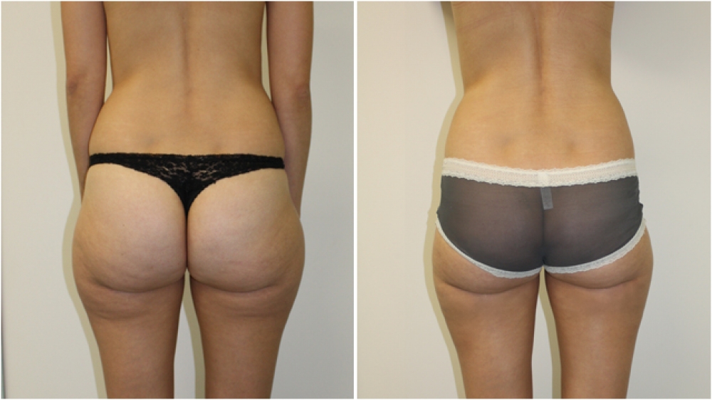 This 30 year old lady underwent liposuction to her outer thighs, buttocks and flanks to achieve a more streamlined appearance.