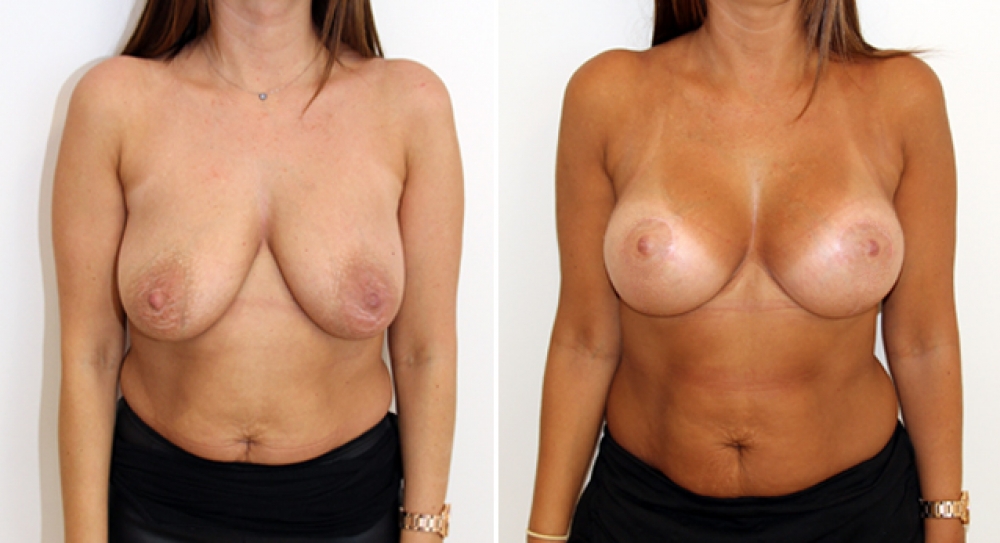 Late 30s, breastfed, augmentation mastopexy (breast lift and implants) with round 385g implants.