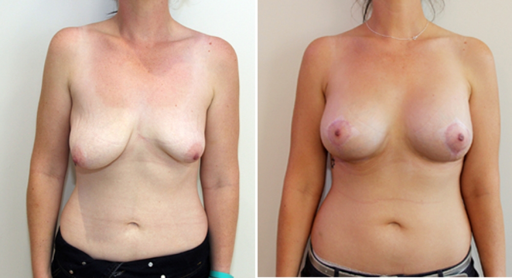 20s, asymmetric tuberous breasts corrected and augmented with vertical and periareolar approach.