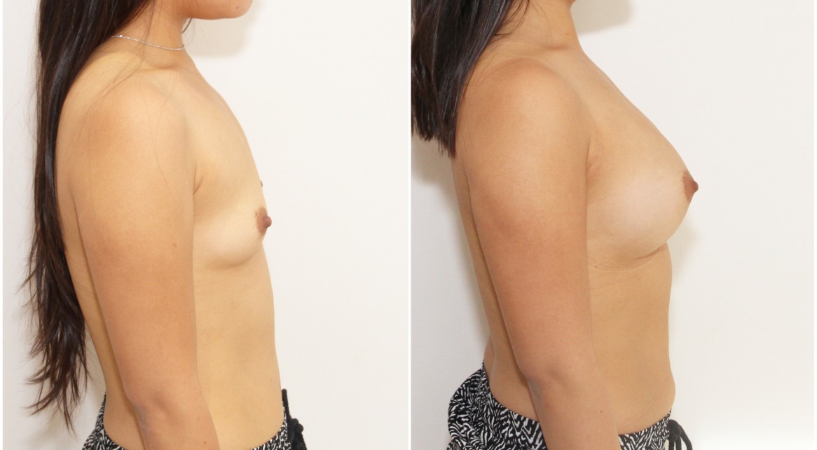 Bilateral breast augmentation. 20s, 330g, dual plane 1, anatomical implants, memory shape gel.