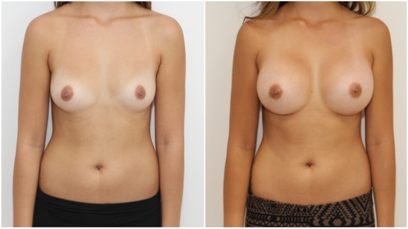 Bilateral breast augmentation. 20s, asymmetry in volume, corrected & enhanced with 350cc round implant on right and 400cc implant on the left, dual plane placement.