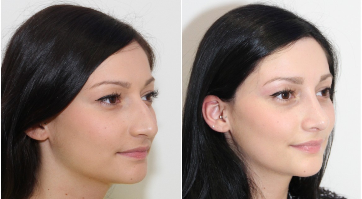 Nose Surgery Rhinoplasty Dr Michael Miroshnik
