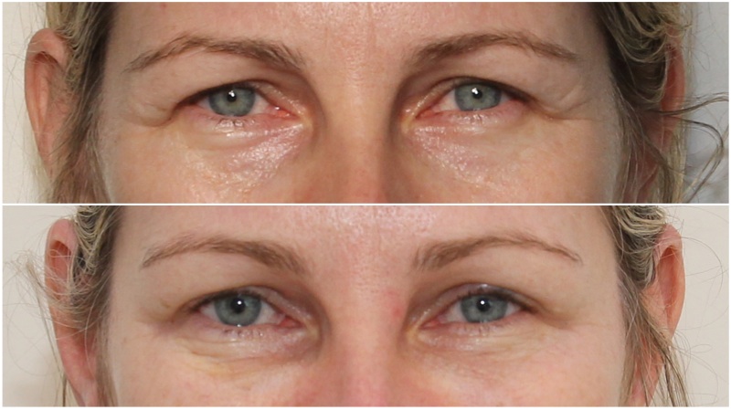 under eye anti wrinkle injections