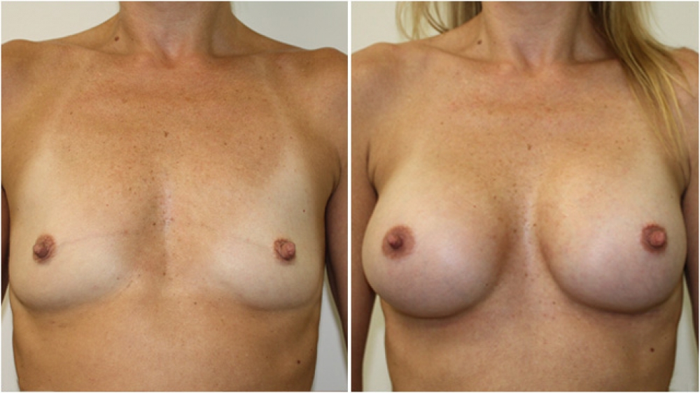 Breast augmentation isn't just about sizehere's how smaller implants can help you love your breasts